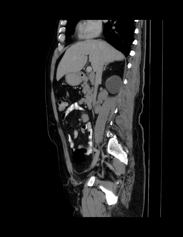 Abdominal lymphoma - with sandwich sign (Radiopaedia 53486-59492 Sagittal C+ portal venous phase 49).jpg