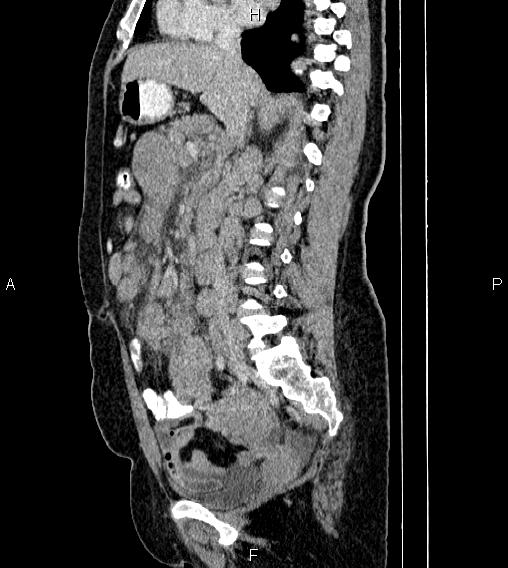 File:Abdominal lymphoma with sandwich sign (Radiopaedia 84378-99704 Sagittal C+ portal venous phase 39).jpg