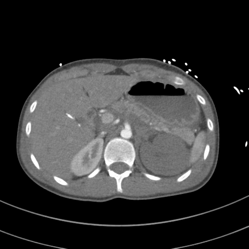 File:Abdominal multi-trauma - devascularised kidney and liver, spleen and pancreatic lacerations (Radiopaedia 34984-36486 Axial C+ arterial phase 94).png