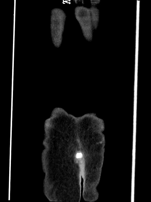 Abdominal wall and retroperitoneal tuberculosis (Radiopaedia 88137-104729 Coronal C+ portal venous phase 105).jpg
