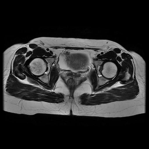 File:Abdominal wall endometriosis (Radiopaedia 83702-98847 Axial T2 14).jpg
