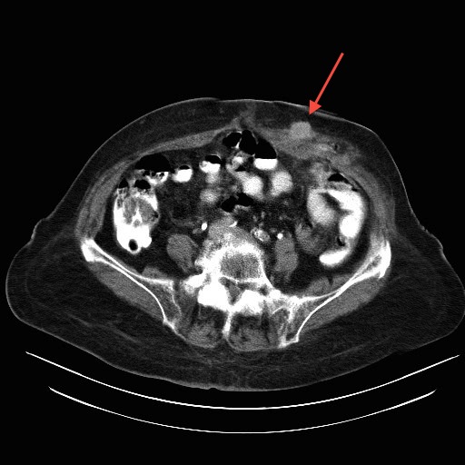File:Abdominal wall recurrence after colorectal resection for cancer (Radiopaedia 23444-23524 C 1).jpg