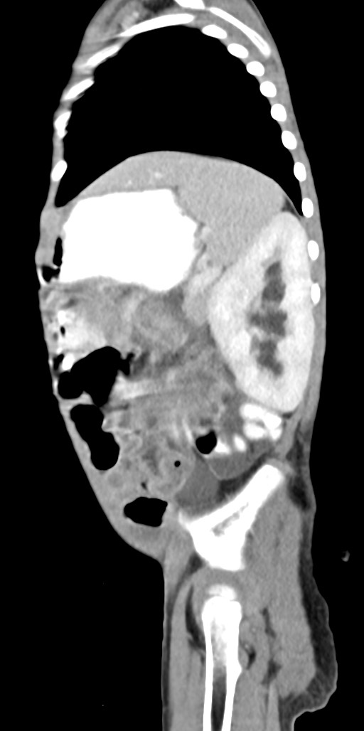 Abdominopelvic rhabdomyosarcoma (Radiopaedia 78356-90984 Sagittal C+ portal venous phase 24).jpg