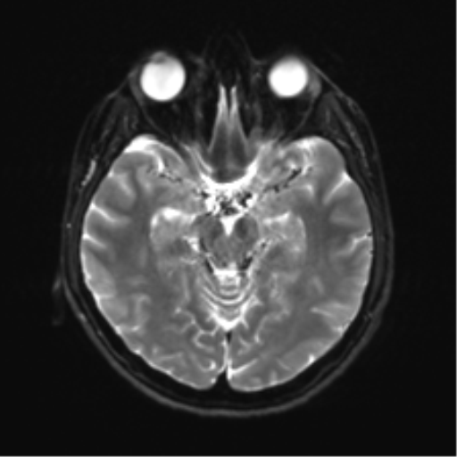 Abducens nerve palsy (Radiopaedia 51069-56648 Axial DWI 10).png