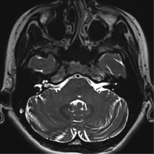 Abducens nerve palsy (Radiopaedia 51069-56648 Axial T2 fat sat 22).png