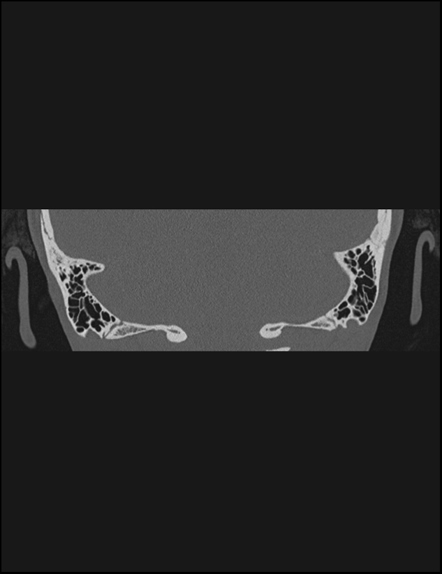Aberrant right internal carotid artery (Radiopaedia 65191-74198 Coronal non-contrast 72).jpg