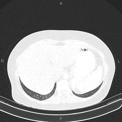 Aberrant right subclavian artery (Radiopaedia 87334-103629 Axial lung window 61).jpg