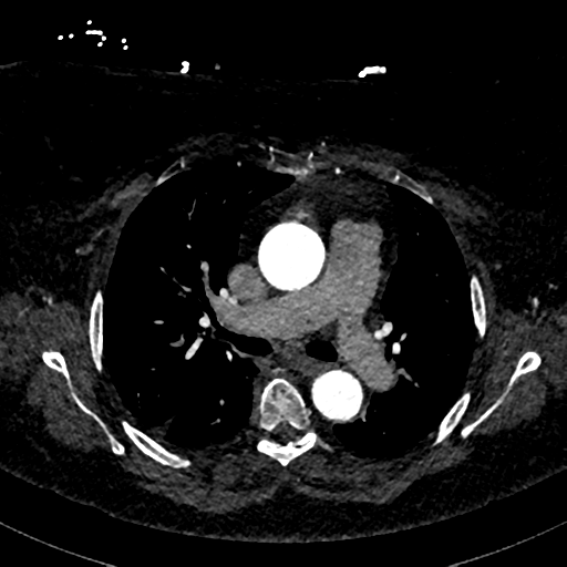 File:Aberrant right subclavian artery with Kommerell diverticulum (Radiopaedia 47982-52769 Axial C+ arterial phase 39).png