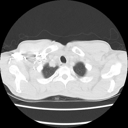 Accessory left horizontal fissure with lingular pneumonia (Radiopaedia 53763-59843 Axial lung window 7).jpg