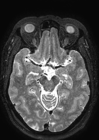 File:Accessory middle cerebral artery (Radiopaedia 73114-83828 Axial T2 112).jpg