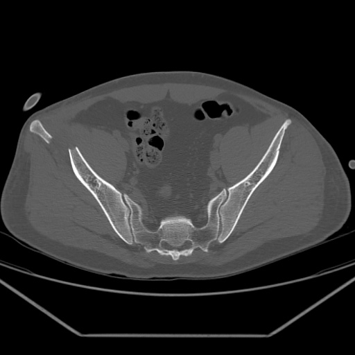 File:Acetabular and ilial fractures (Radiopaedia 59084-66378 Axial bone window 26).jpg