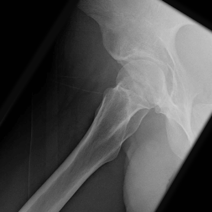 File:Acetabular fracture (Radiopaedia 49088-54189 Oblique 1).jpeg