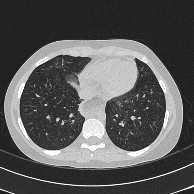 Achalasia (Radiopaedia 14946-14878 Axial lung window 57).jpg