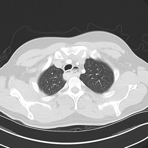 Achalasia of the cardia (Radiopaedia 38497-40595 Axial lung window 11).png