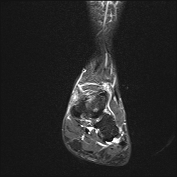 File:Achilles tendon tear (Radiopaedia 77615-89819 Coronal STIR 11).jpg
