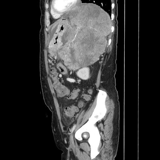 Acinar cell carcinoma of the pancreas (Radiopaedia 75442-86669 Sagittal C+ portal venous phase 135).jpg