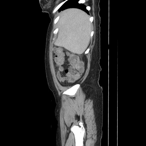 Acinar cell carcinoma of the pancreas (Radiopaedia 75442-86669 Sagittal C+ portal venous phase 39).jpg