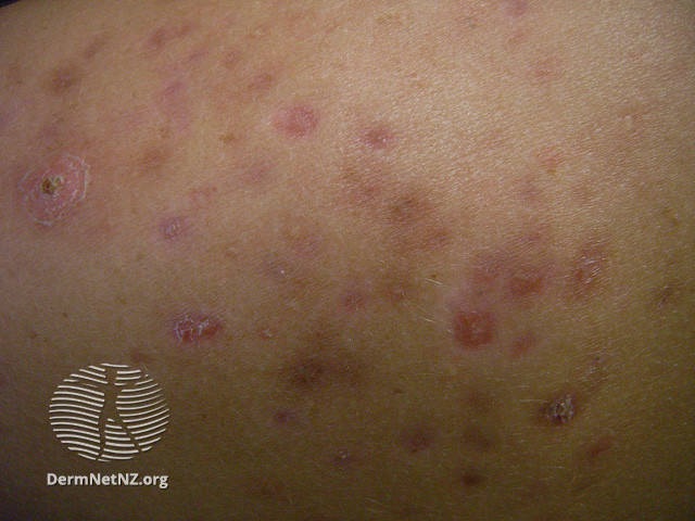 File:Acne affecting the back images (DermNet NZ acne-acne-back-154).jpg