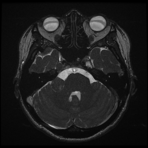File:Acoustic neuroma (Radiopaedia 34049-35283 Axial 62).png