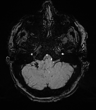 File:Acoustic schwannoma (Radiopaedia 50846-56358 Axial SWI 17).png