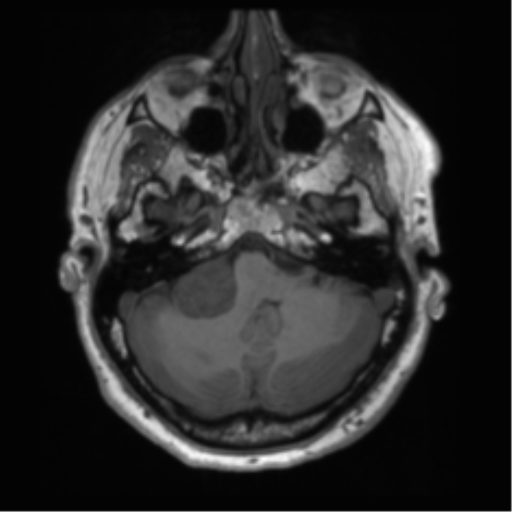 File:Acoustic schwannoma (Radiopaedia 50846-56358 Axial T1 17).png
