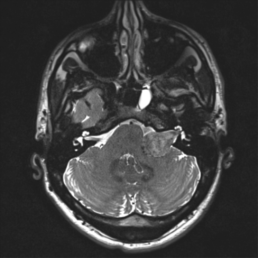 Acoustic schwannoma (translabyrinthine resection) (Radiopaedia 43570-46969 Coronal FIESTA 73).png