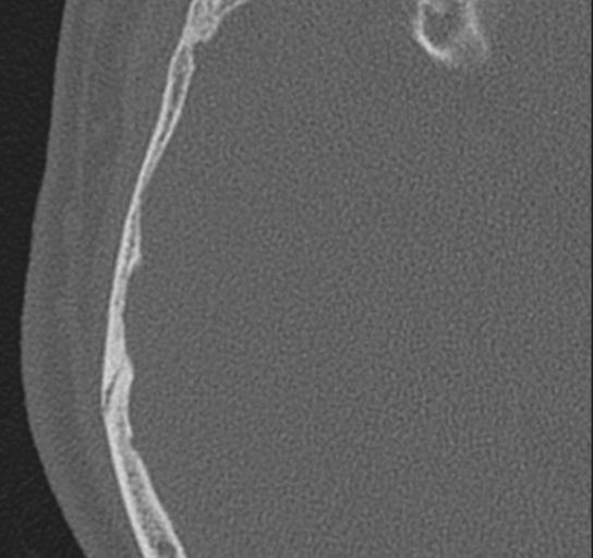 Acoustic schwannoma - cystic (Radiopaedia 29487-29980 AXIAL RIGHT bone window 3).jpg