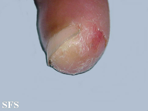 Acrodermatitis Continua (Dermatology Atlas 5).jpg