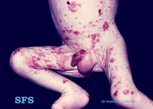 File:Acrodermatitis Enteropathica (Dermatology Atlas 4).jpg