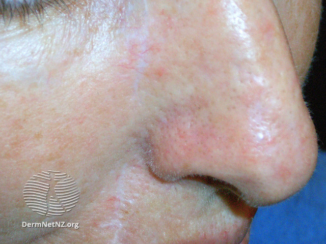File:Actinic Keratoses treated with imiquimod (DermNet NZ lesions-ak-imiquimod-3724).jpg