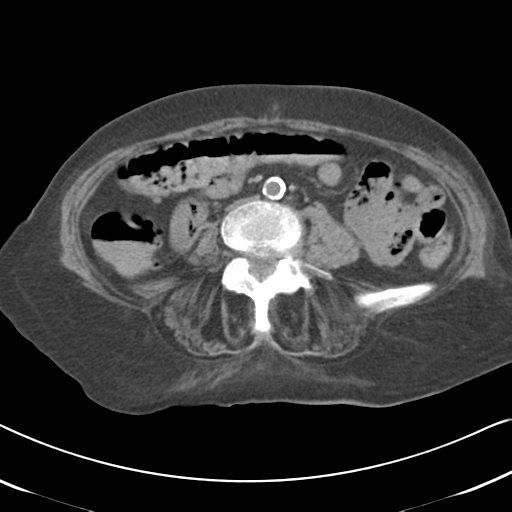 Active bleeding from duodenal ulcer with embolization (Radiopaedia 34216-35481 Axial non-contrast 37).png