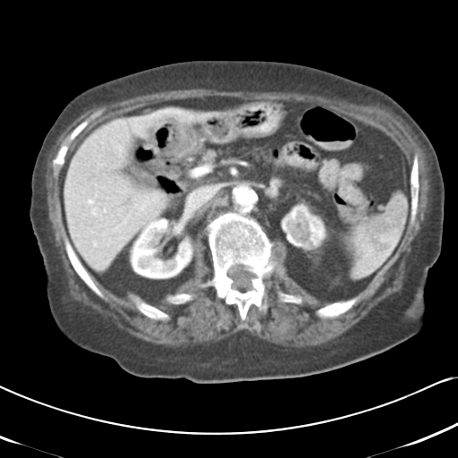 File:Active bleeding from duodenal ulcer with embolization (Radiopaedia 34216-35481 C 22).png