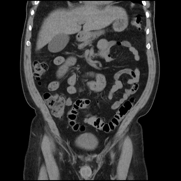 Active colonic bleed on CT (Radiopaedia 49765-55025 Coronal non-contrast 20).jpg
