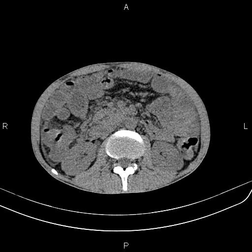 Active crohn disease (Radiopaedia 87133-103397 Axial non-contrast 45).jpg