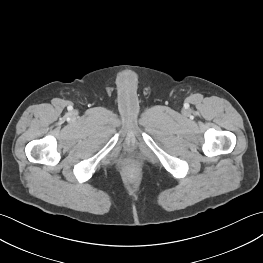 File:Active diverticular hemorrhage (Radiopaedia 39415-41725 Axial C+ portal venous phase 79).png
