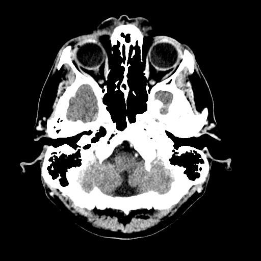 File:Active neurocysticercosis before and after therapy (Radiopaedia 71710-82099 Axial C+ delayed 87).jpg