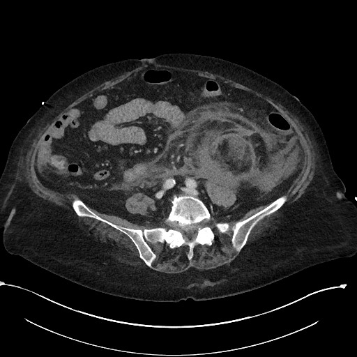 File:Active renal extravasation with large subcapsular and retroperitoneal hemorrhage (Radiopaedia 60975-68796 Axial 240).jpg