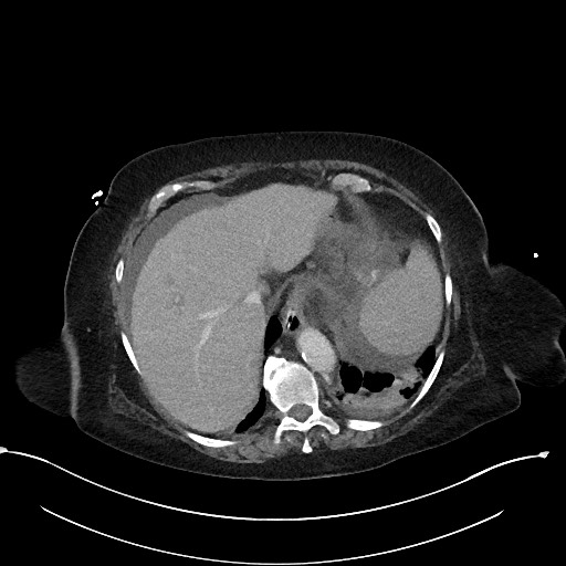 File:Active renal extravasation with large subcapsular and retroperitoneal hemorrhage (Radiopaedia 60975-68796 Axial 327).jpg