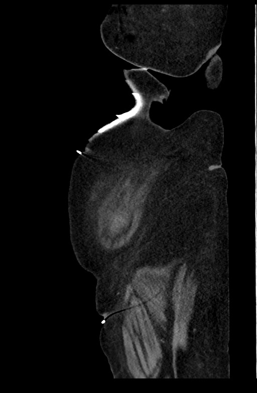 Active renal extravasation with large subcapsular and retroperitoneal hemorrhage (Radiopaedia 60975-68796 Sagittal C+ portal venous phase 34).jpg