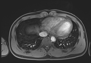 File:Active right ventricular cardiac sarcoidosis (Radiopaedia 55596-62100 Axial Post contrast Dixon 58).jpg