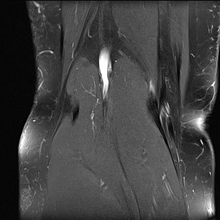 File:Acute-on-chronic transient lateral patellar dislocation with trochlear dysplasia (Radiopaedia 84099-99349 Coronal PD fat sat 8).jpg