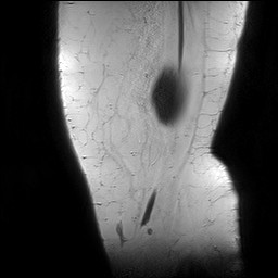 Acute-on-chronic transient lateral patellar dislocation with trochlear dysplasia (Radiopaedia 84099-99349 Sagittal PD 6).jpg