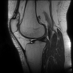 Acute-on-chronic transient lateral patellar dislocation with trochlear dysplasia (Radiopaedia 84099-99349 Sagittal PD 98).jpg