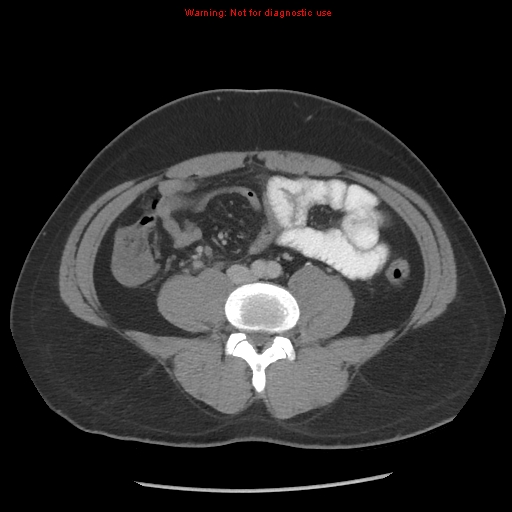 Acute appendicitis (Radiopaedia 10498-10973 Axial C+ portal venous phase 10).jpg