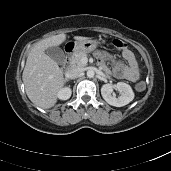Acute appendicitis (Radiopaedia 48792-53822 Axial C+ portal venous phase 38).jpg