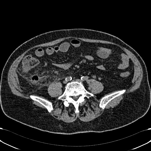 Acute appendicitis (Radiopaedia 58627-65818 Axial non-contrast 57).jpg