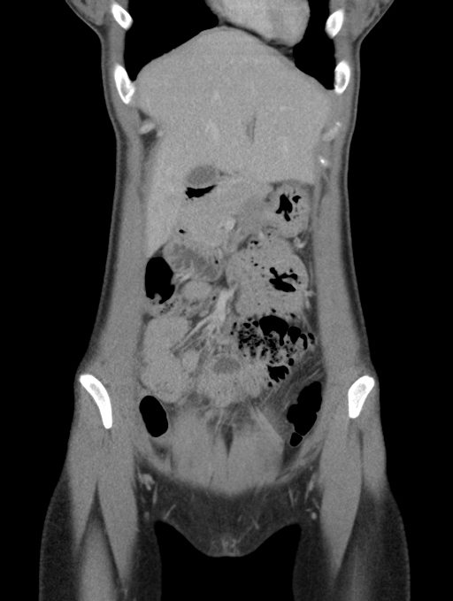 Acute appendicitis (Radiopaedia 62608-70901 Coronal C+ portal venous phase 7).jpg
