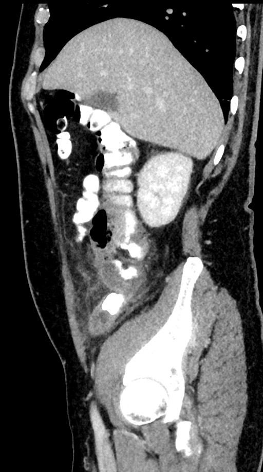 Acute appendicitis (Radiopaedia 77016-88960 Sagittal C+ portal venous phase 85).jpg
