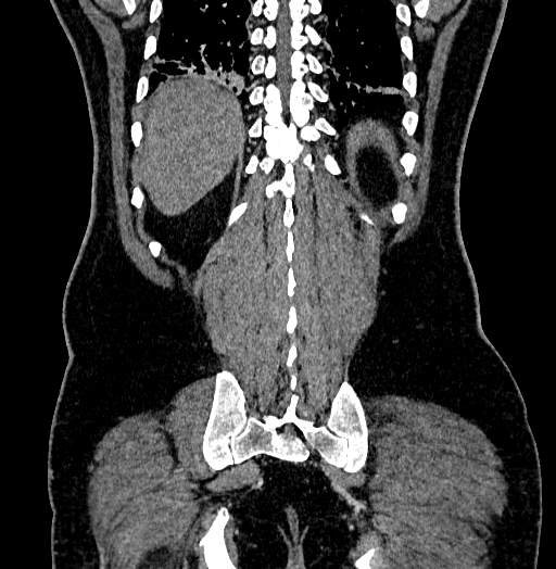 Acute appendicitis (Radiopaedia 79950-93224 Coronal C+ portal venous phase 79).jpg