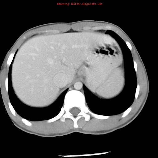 Acute appendicitis (Radiopaedia 8195-9045 Axial C+ portal venous phase 12).jpg